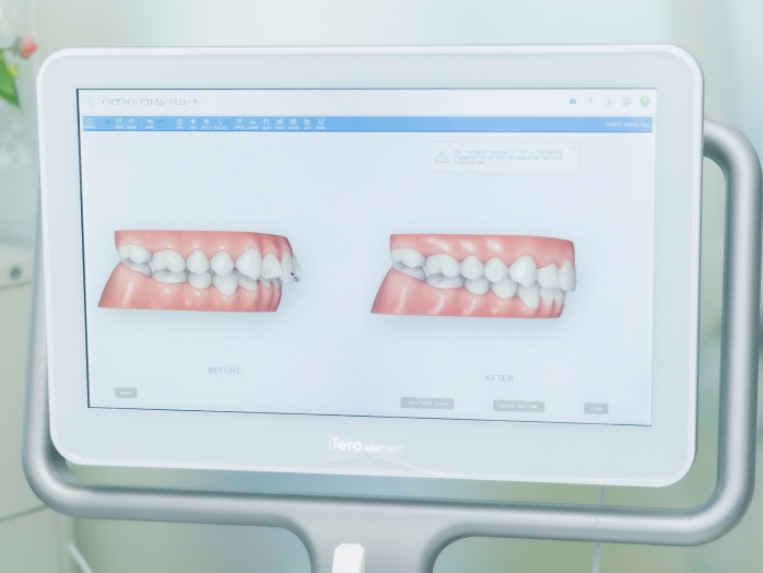 口腔内スキャナー